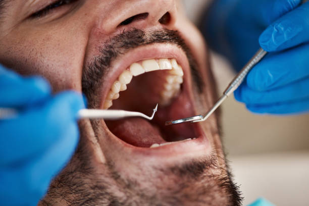 Teeth Whitening in GA